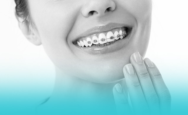 Diş Teli Tedavisi Nedir ?